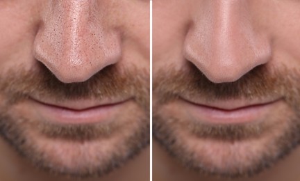 Image of Blackhead treatment, before and after. Collage with photos of man, closeup view