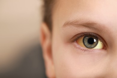 Photo of Closeup view of little girl with yellow eyes on blurred background, space for text. Hepatitis symptom