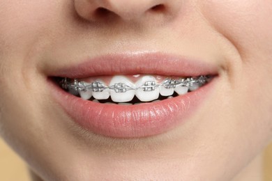 Smiling woman with dental braces, closeup view