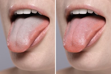 Image of Woman showing her tongue before and after cleaning procedure, closeup. Tongue coated with plaque on one side and healthy on other, collage