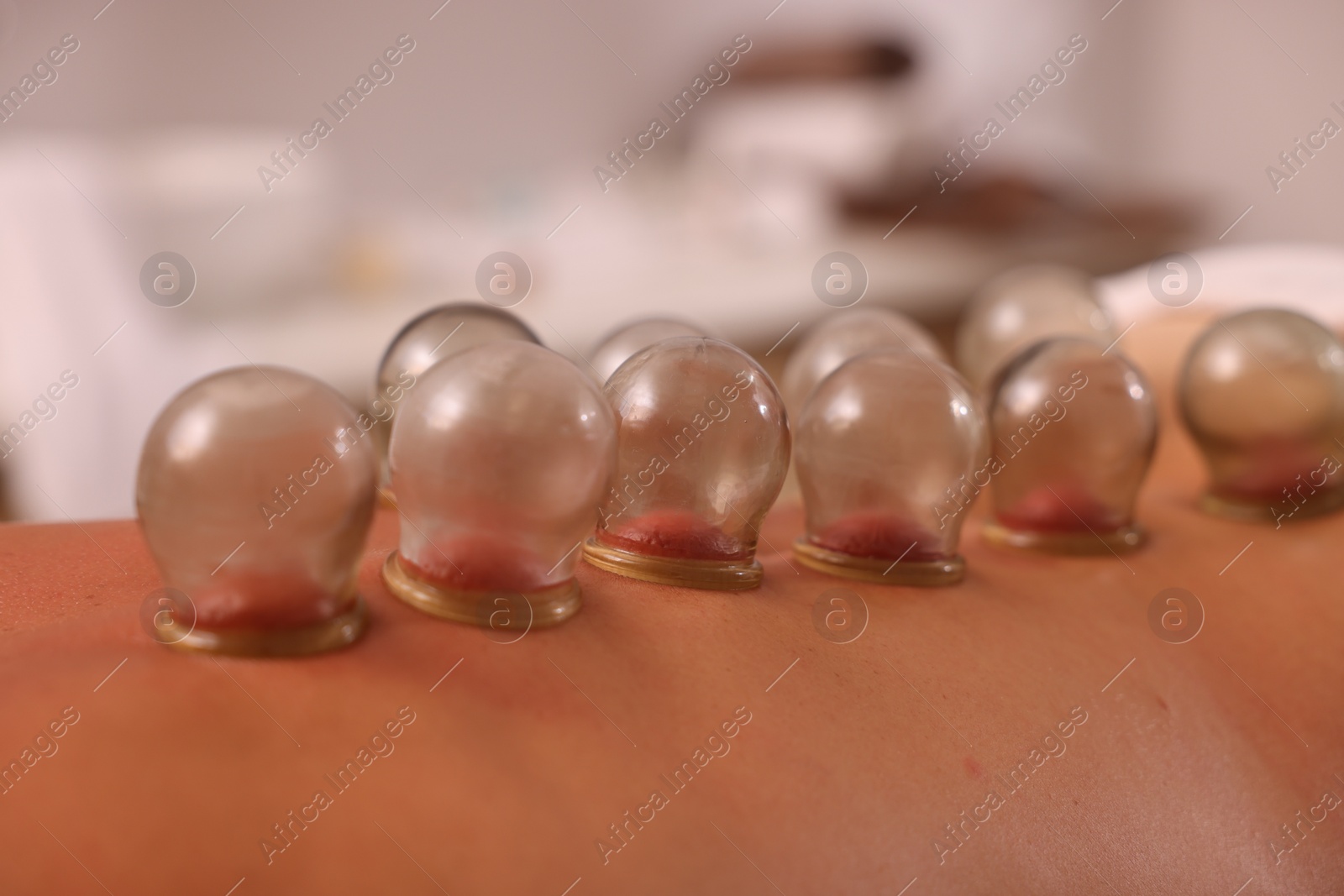 Photo of Cupping therapy. Closeup view of man with glass cups on his back indoors