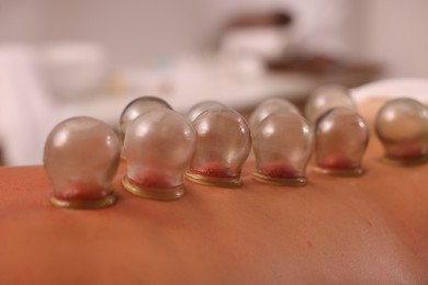 Cupping therapy. Closeup view of man with glass cups on his back indoors