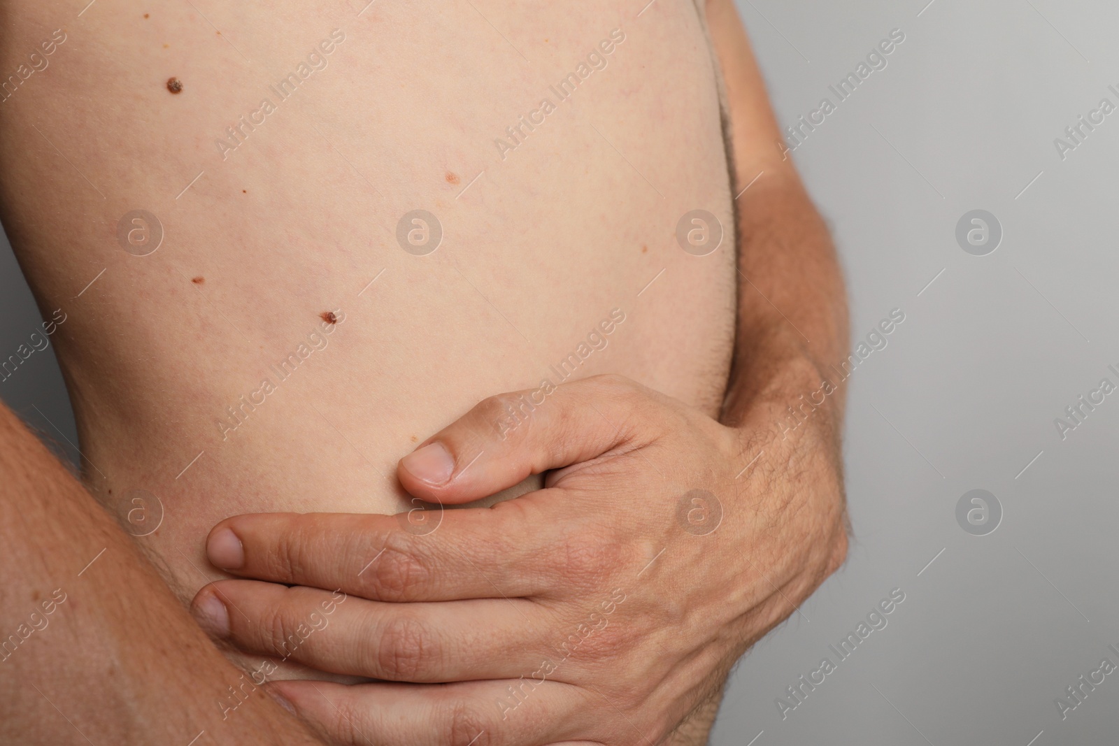 Photo of Closeup of man's body with birthmarks on light grey background
