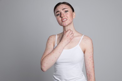 Woman with rash suffering from monkeypox virus on light grey background