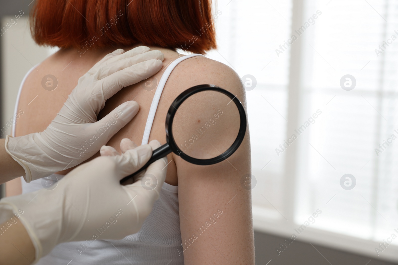 Photo of Dermatologist examining patient's birthmark with magnifying glass in clinic, closeup view