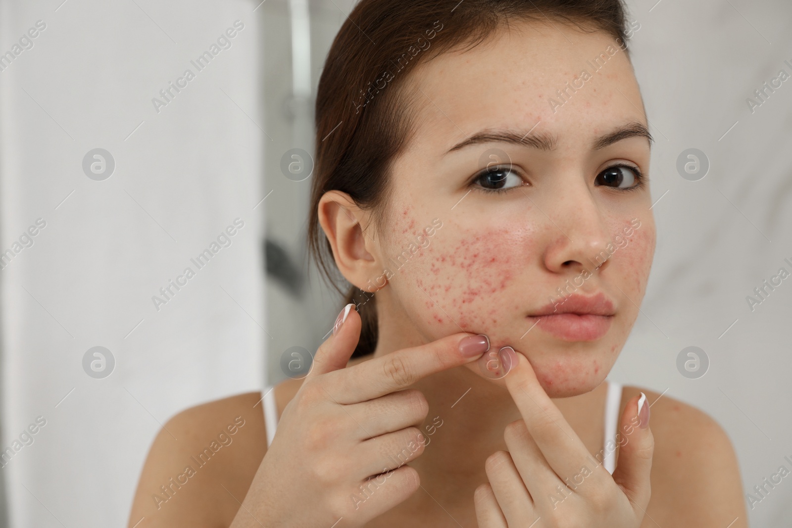 Photo of Teen girl with acne problem squeezing pimple indoors