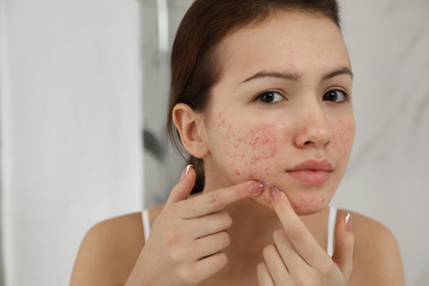 Photo of Teen girl with acne problem squeezing pimple indoors