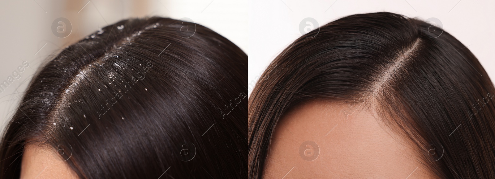 Image of Woman showing hair before and after dandruff treatment, collage