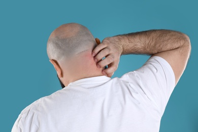 Man with allergy symptoms scratching neck on color background