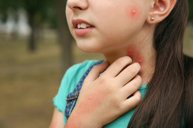 Photo of Girl scratching neck with insect bites in park, closeup