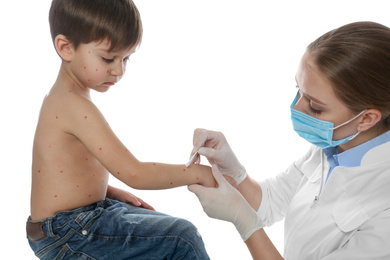 Photo of Doctor applying cream onto skin of little boy with chickenpox against white background. Varicella zoster virus