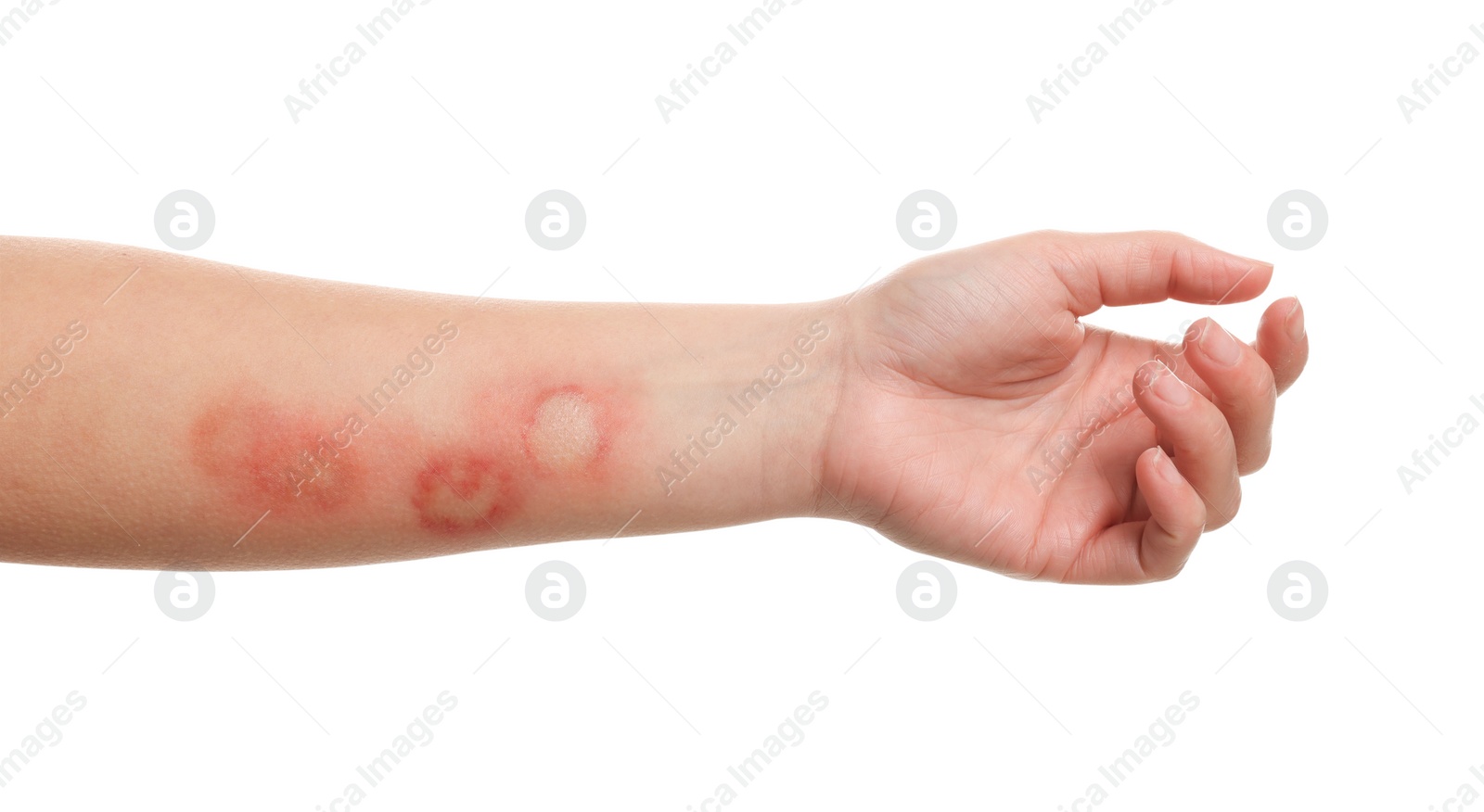 Photo of Woman with burned hand on white background, closeup