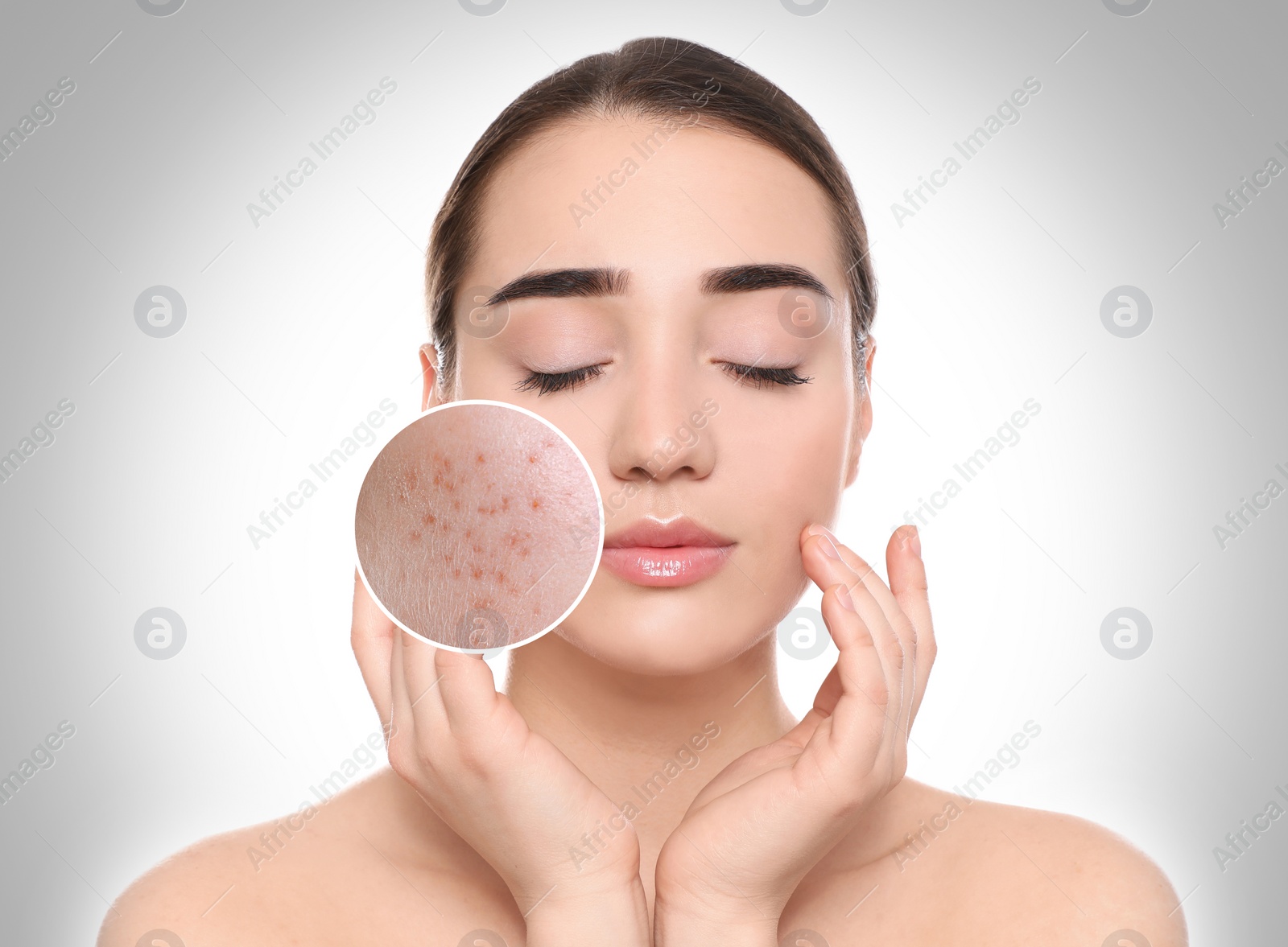 Image of Woman with acne on her face on grey gradient background. Zoomed area showing problem skin