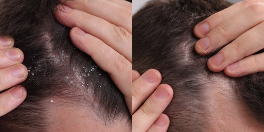 Man showing hair before and after dandruff treatment, collage