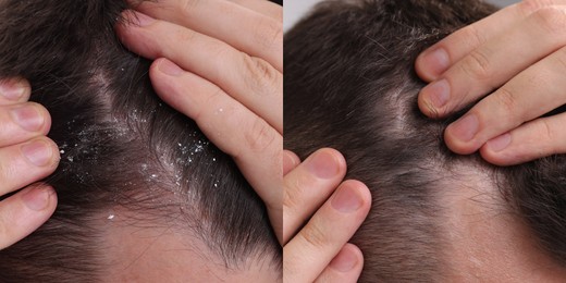 Image of Man showing hair before and after dandruff treatment, collage