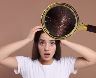 Image of Woman suffering from dandruff on pale brown background. View through magnifying glass on hair with flakes