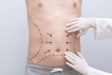 Photo of Doctor examining man's stomach with marker lines on light background