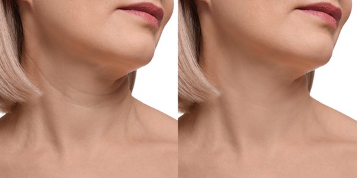 Image of Collage with photos of woman before and after cosmetic procedure on white background, closeup