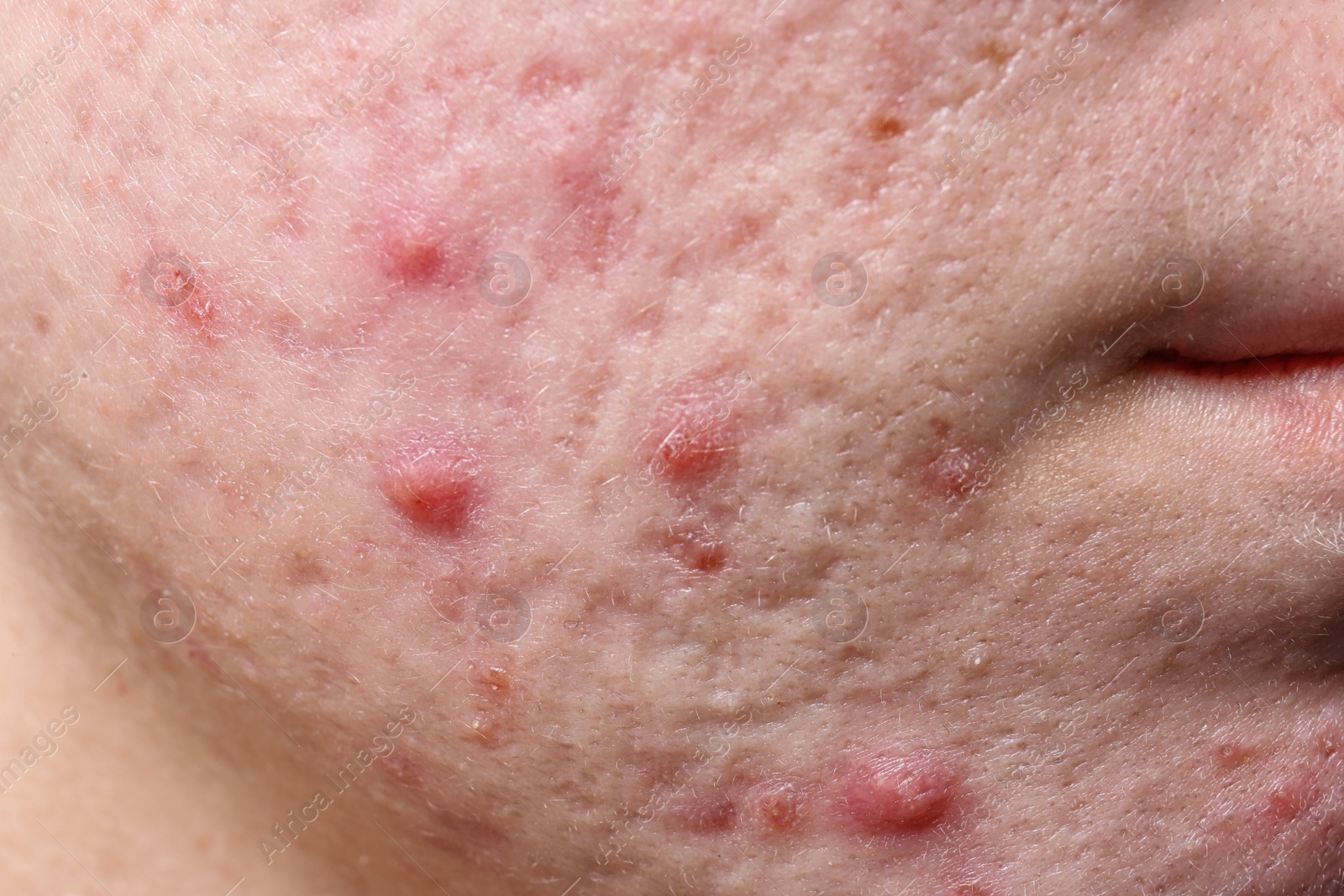 Photo of Young woman with acne on her face, closeup