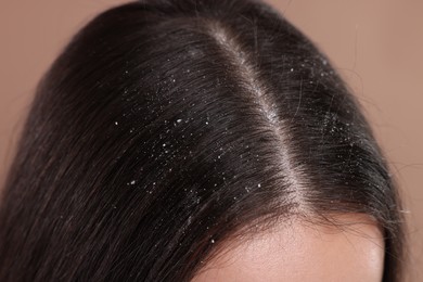 Photo of Woman with dandruff problem on beige background, closeup