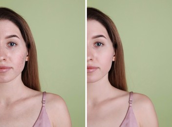 Image of Acne problem. Young woman before and after treatment on green background, collage of photos