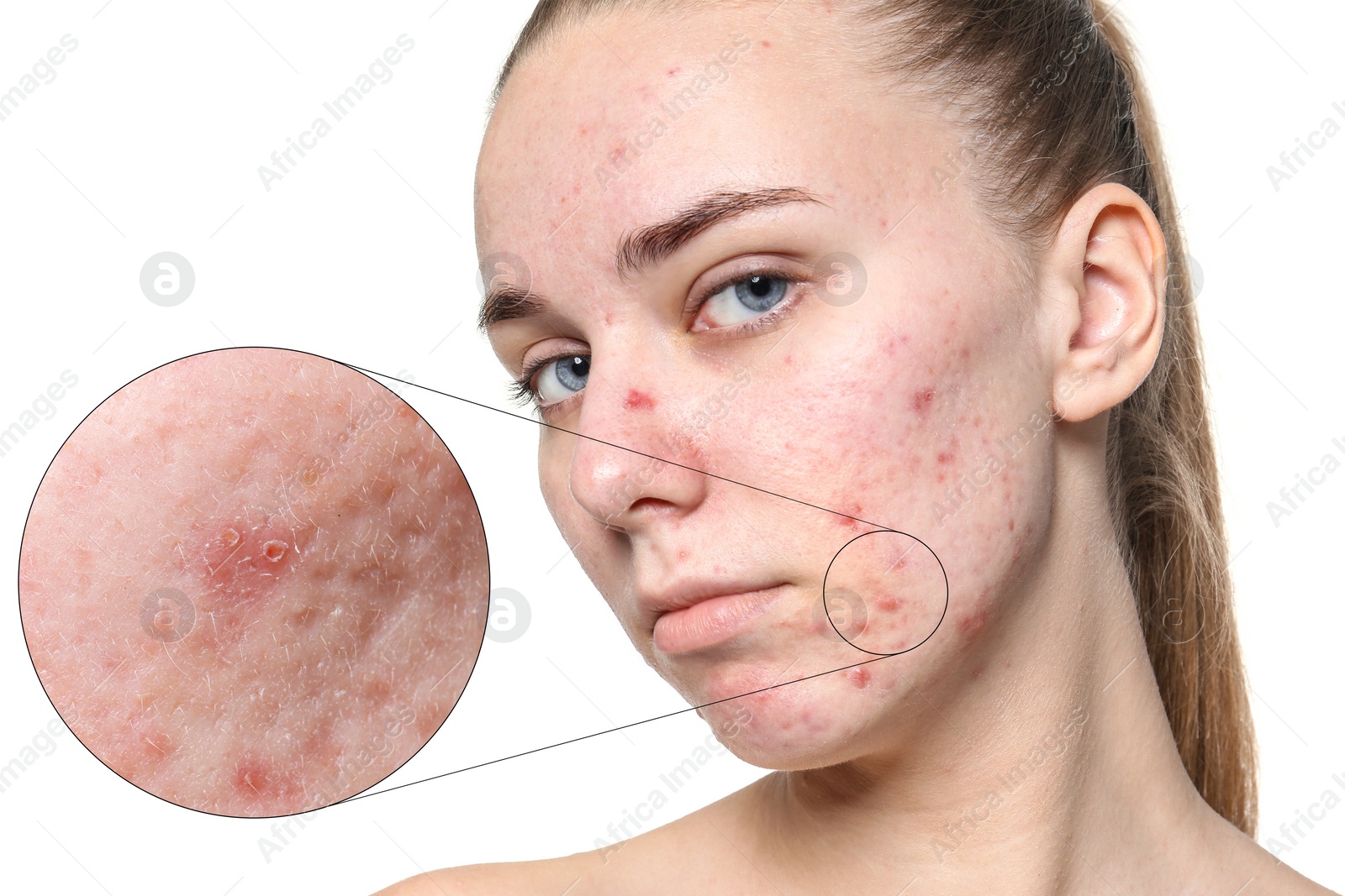 Image of Dermatology. Woman with skin problem on white background. Zoomed area showing acne