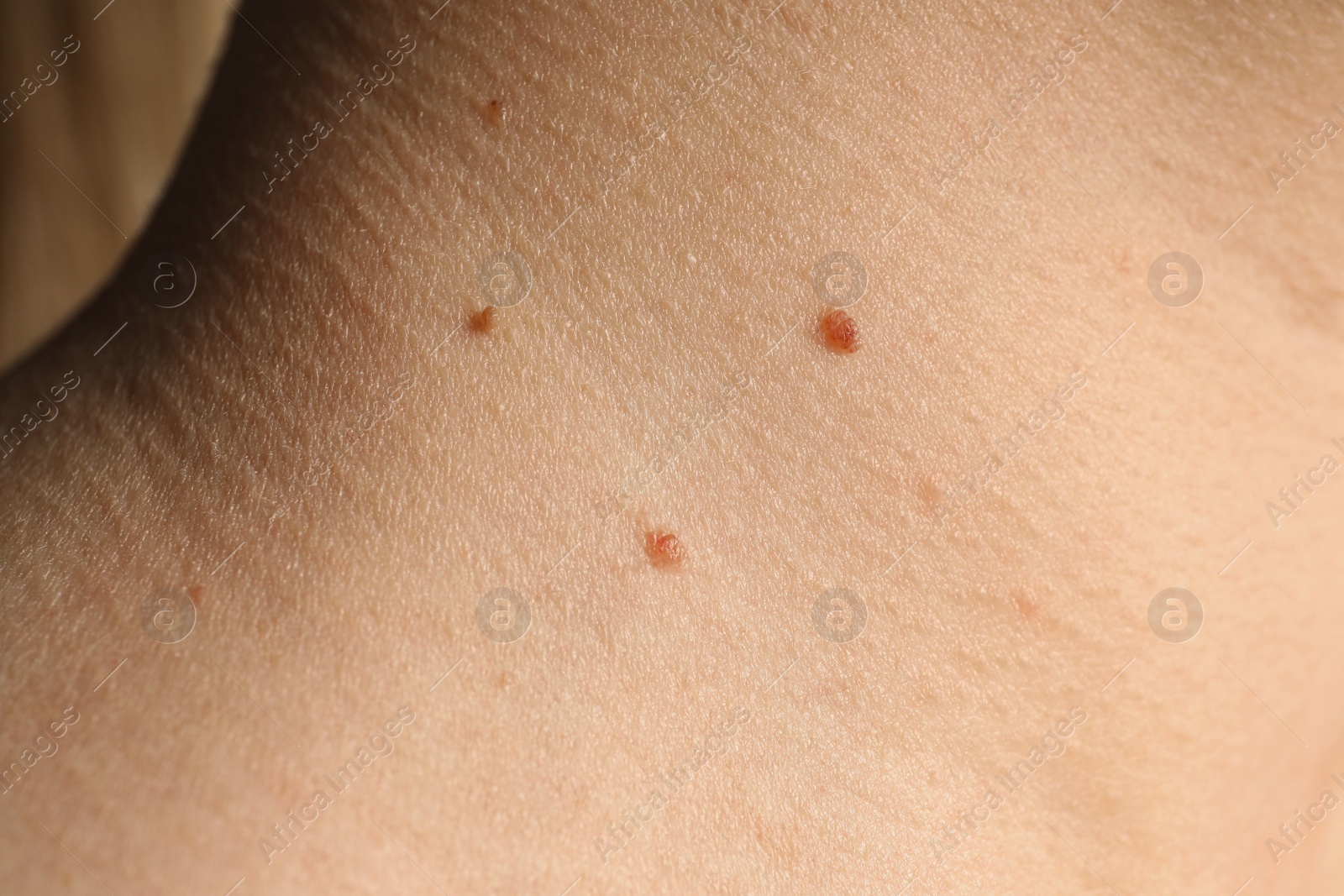 Photo of Closeup view of woman's body with birthmarks