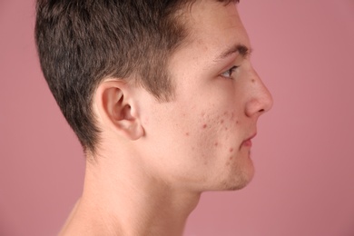 Photo of Young man with acne problem on color background