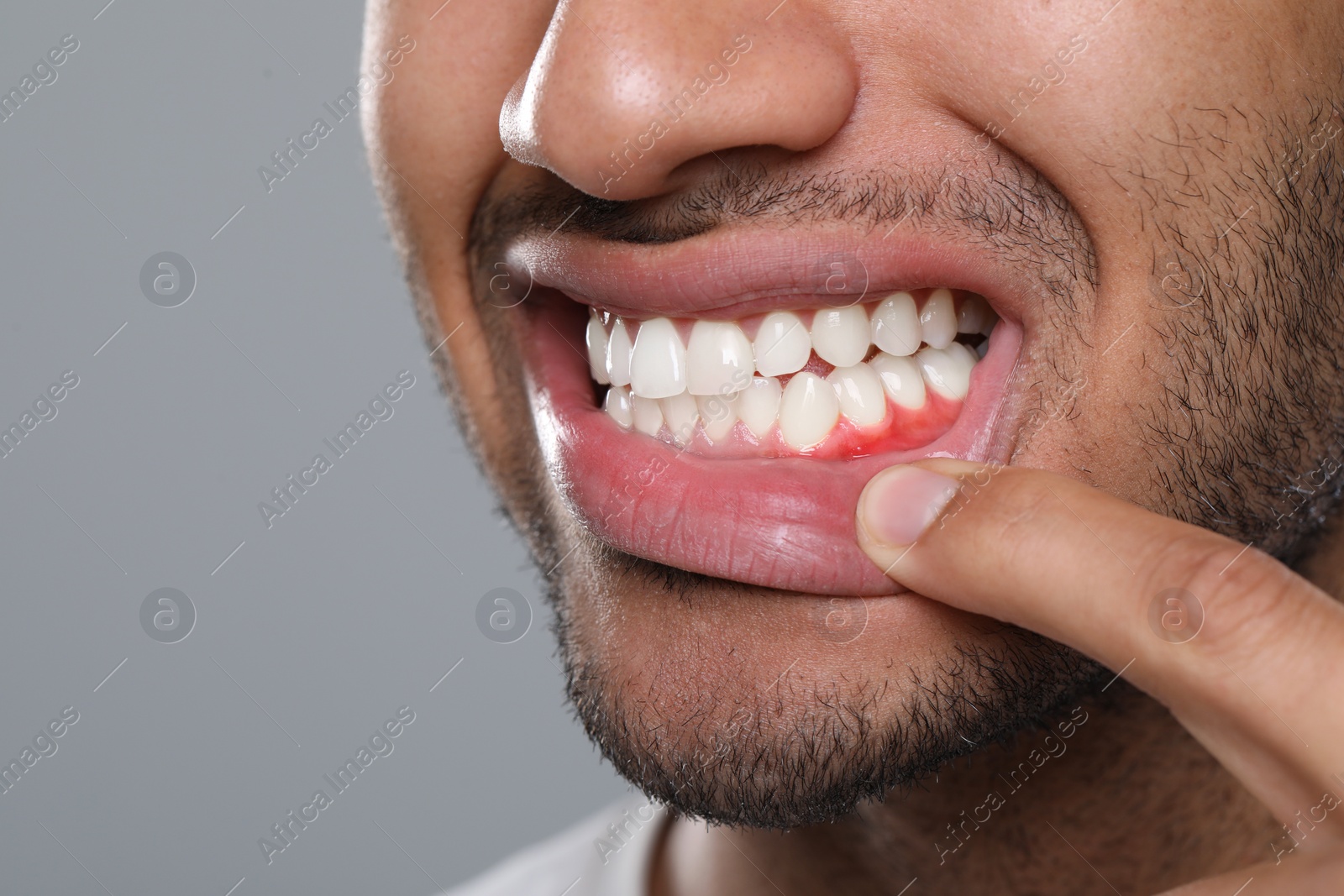 Image of Man showing inflamed gum on grey background, closeup