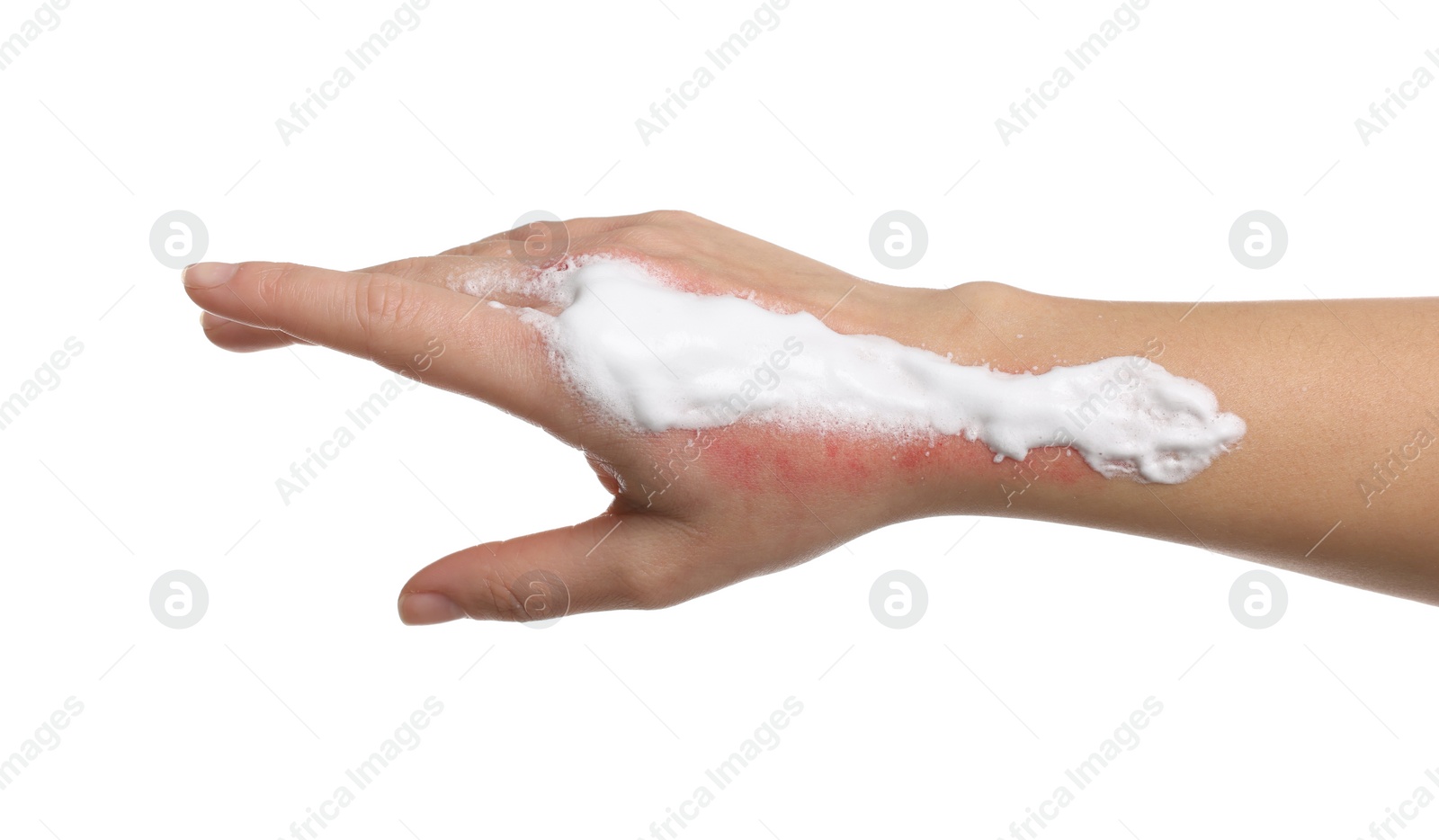 Photo of Woman with panthenol on her burned hand against white background, closeup