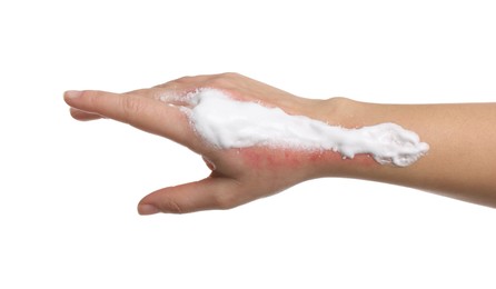 Woman with panthenol on her burned hand against white background, closeup