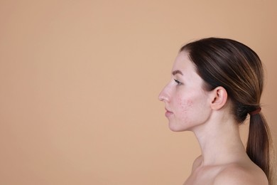 Photo of Young woman with acne problem on beige background. Space for text