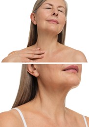 Collage with photos of woman before and after cosmetic procedure on white background