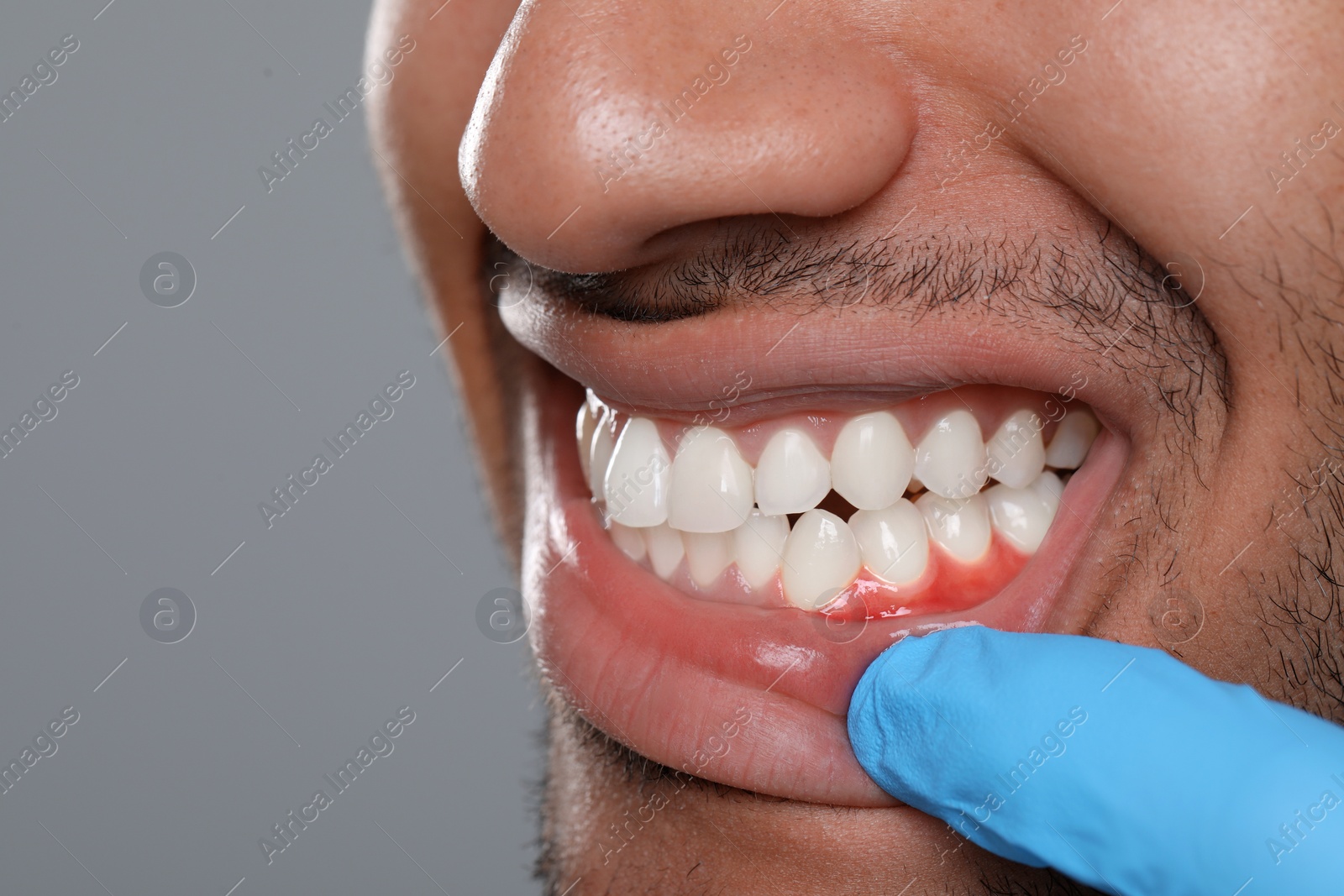 Image of Doctor examining man's inflamed gum on grey background, closeup. Space for text