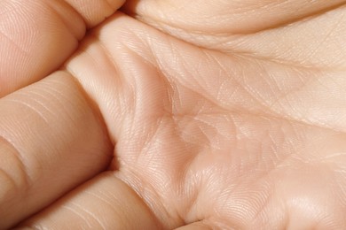 Closeup view of human hand with dry skin