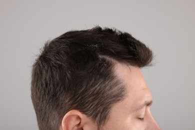 Photo of Man with dandruff in his dark hair on light gray background, closeup
