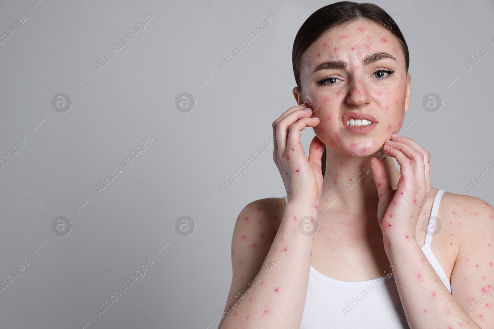 Photo of Woman with rash suffering from monkeypox virus on light grey background. Space for text