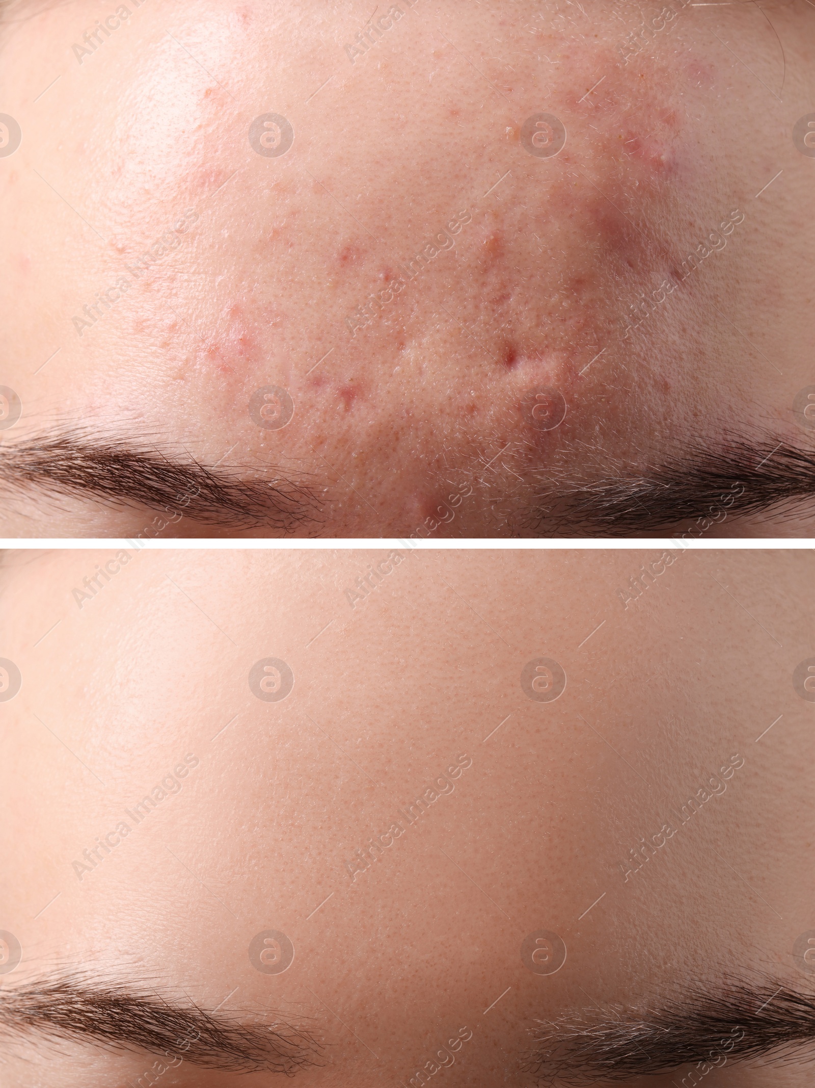 Image of Collage with photos of woman with acne problem before and after treatment, closeup