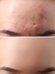 Collage with photos of woman with acne problem before and after treatment, closeup