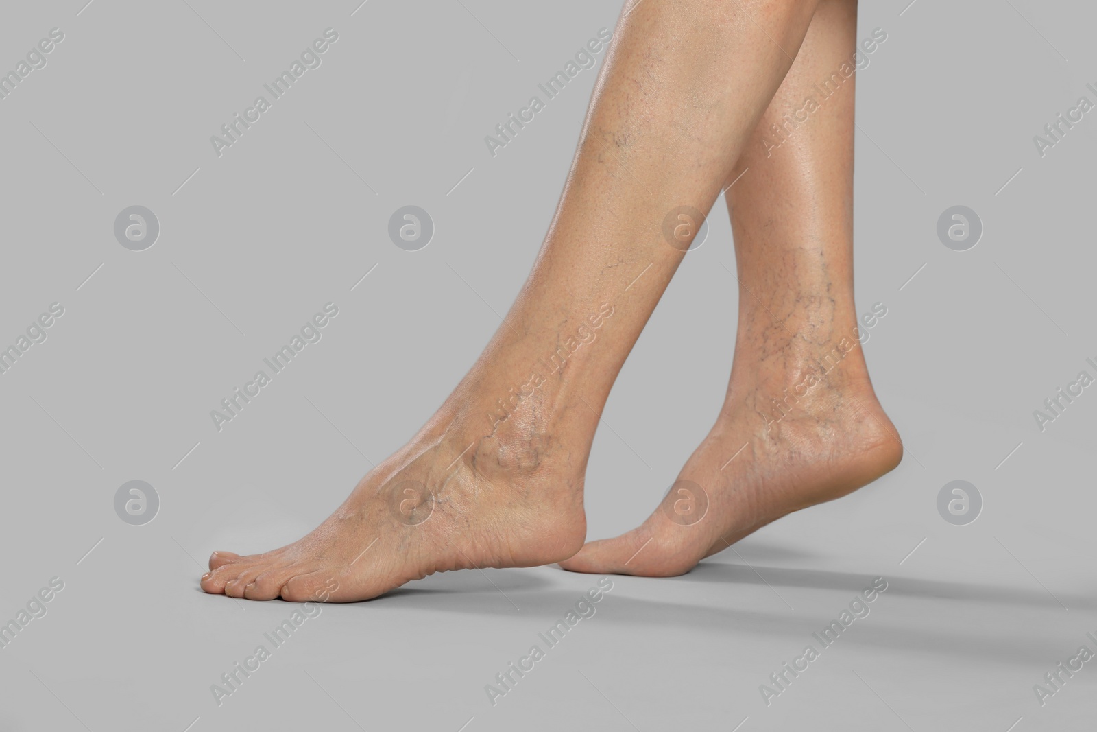 Photo of Closeup view of woman with varicose veins on light grey background