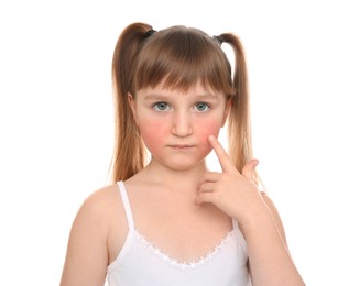 Image of Cute little girl with allergy symptoms on cheeks against white background