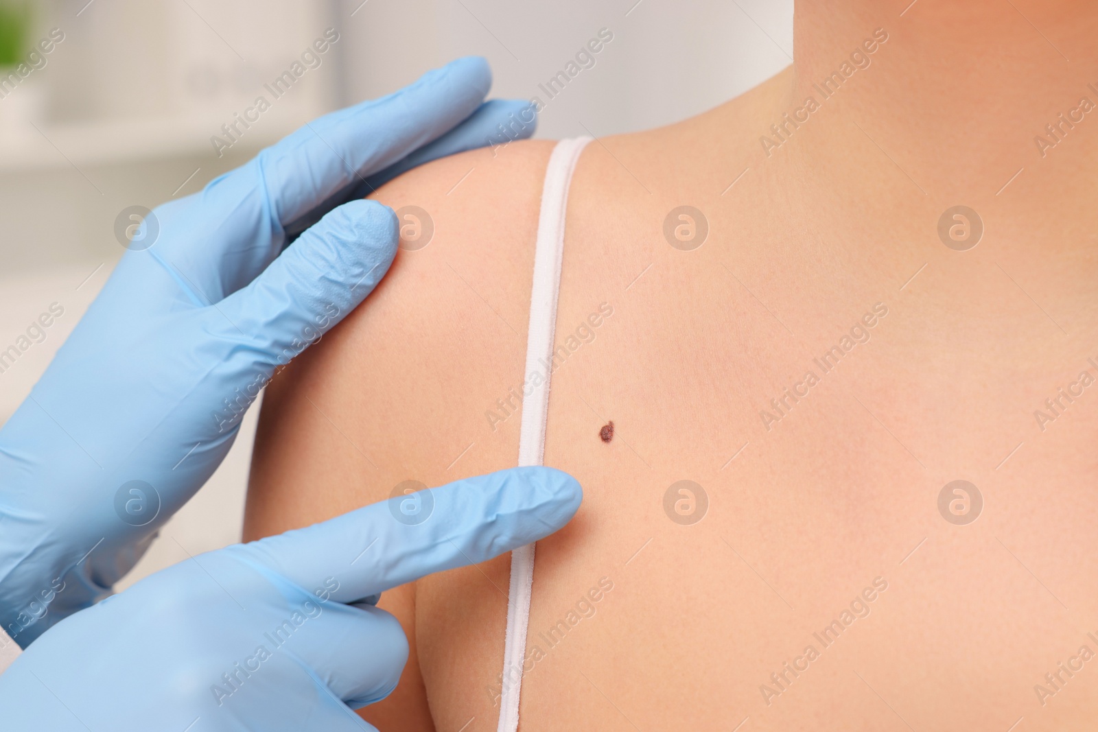 Photo of Dermatologist examining patient's birthmark indoors, closeup view