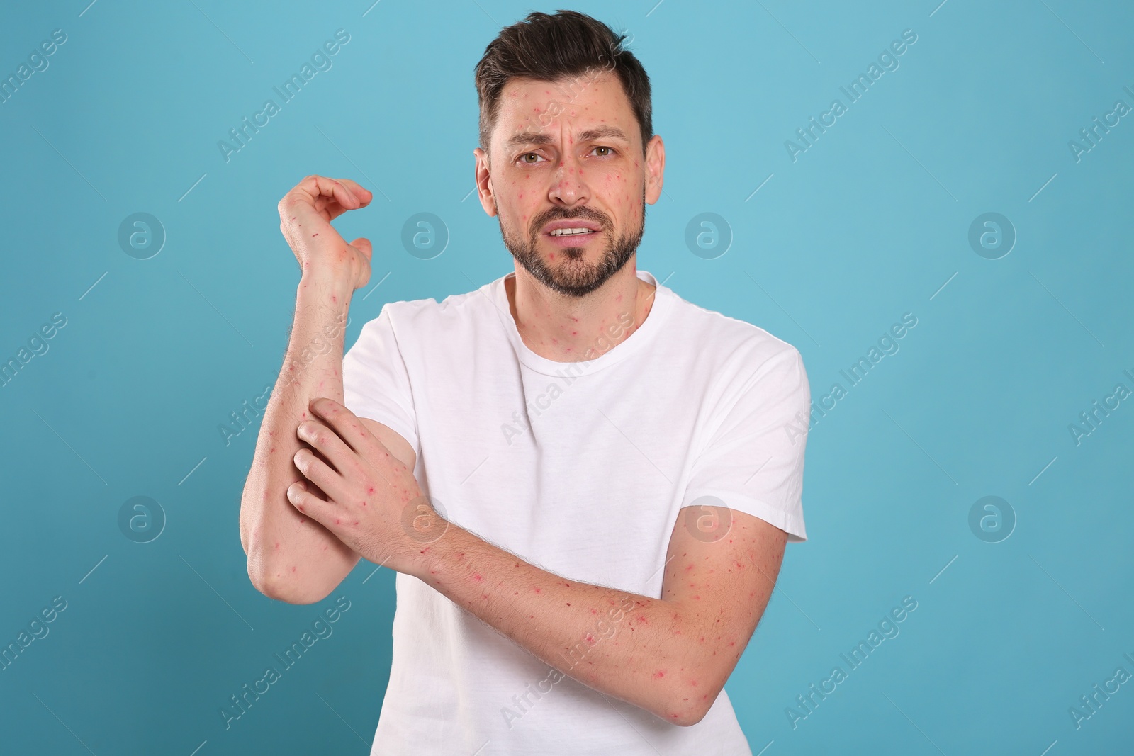 Photo of Man with rash suffering from monkeypox virus on light blue background