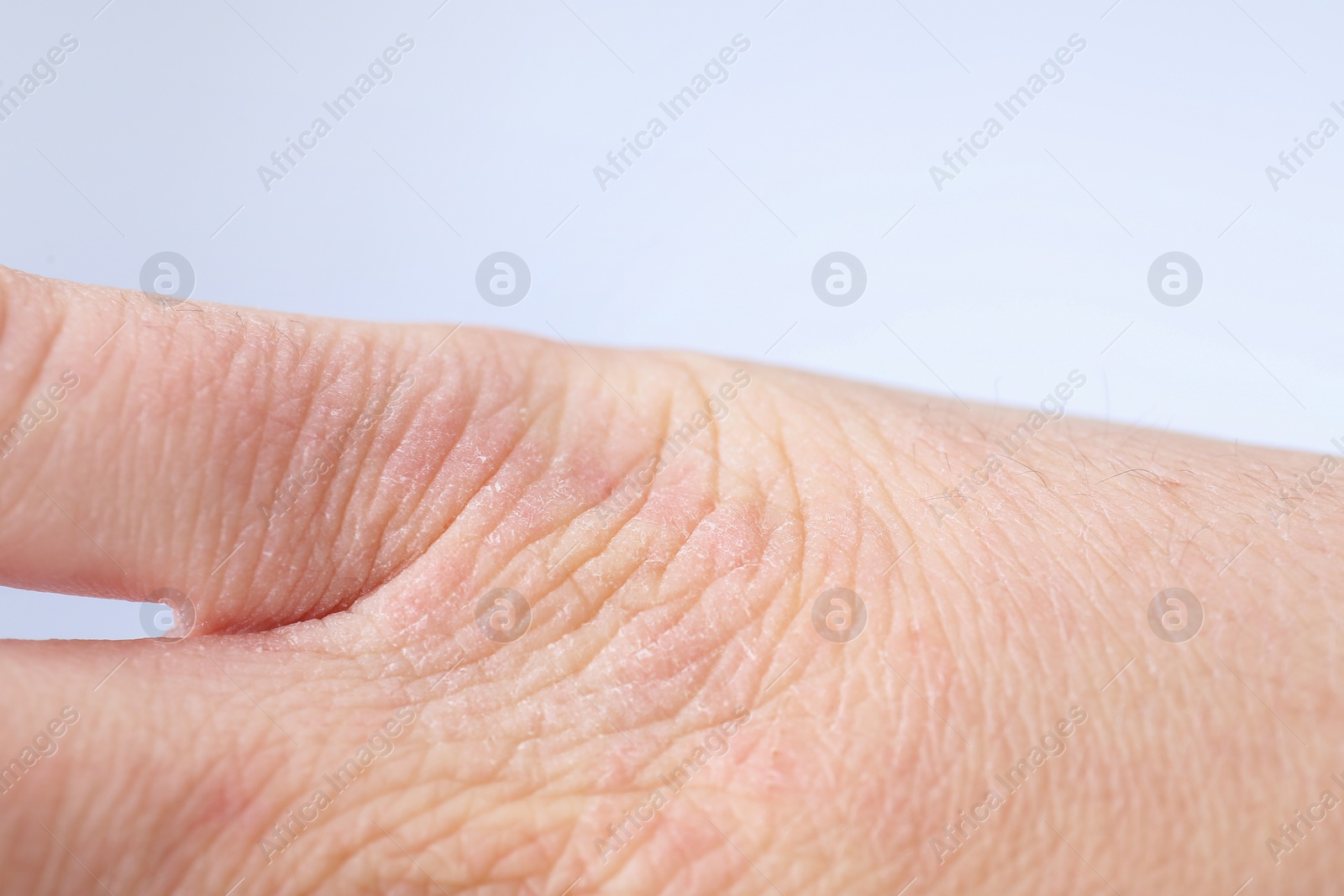 Photo of Woman with dry skin on hand against light background, closeup