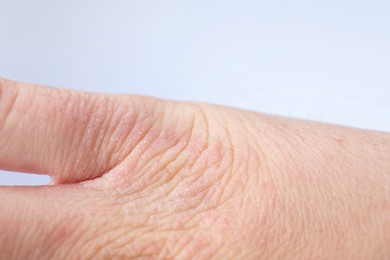 Woman with dry skin on hand against light background, closeup