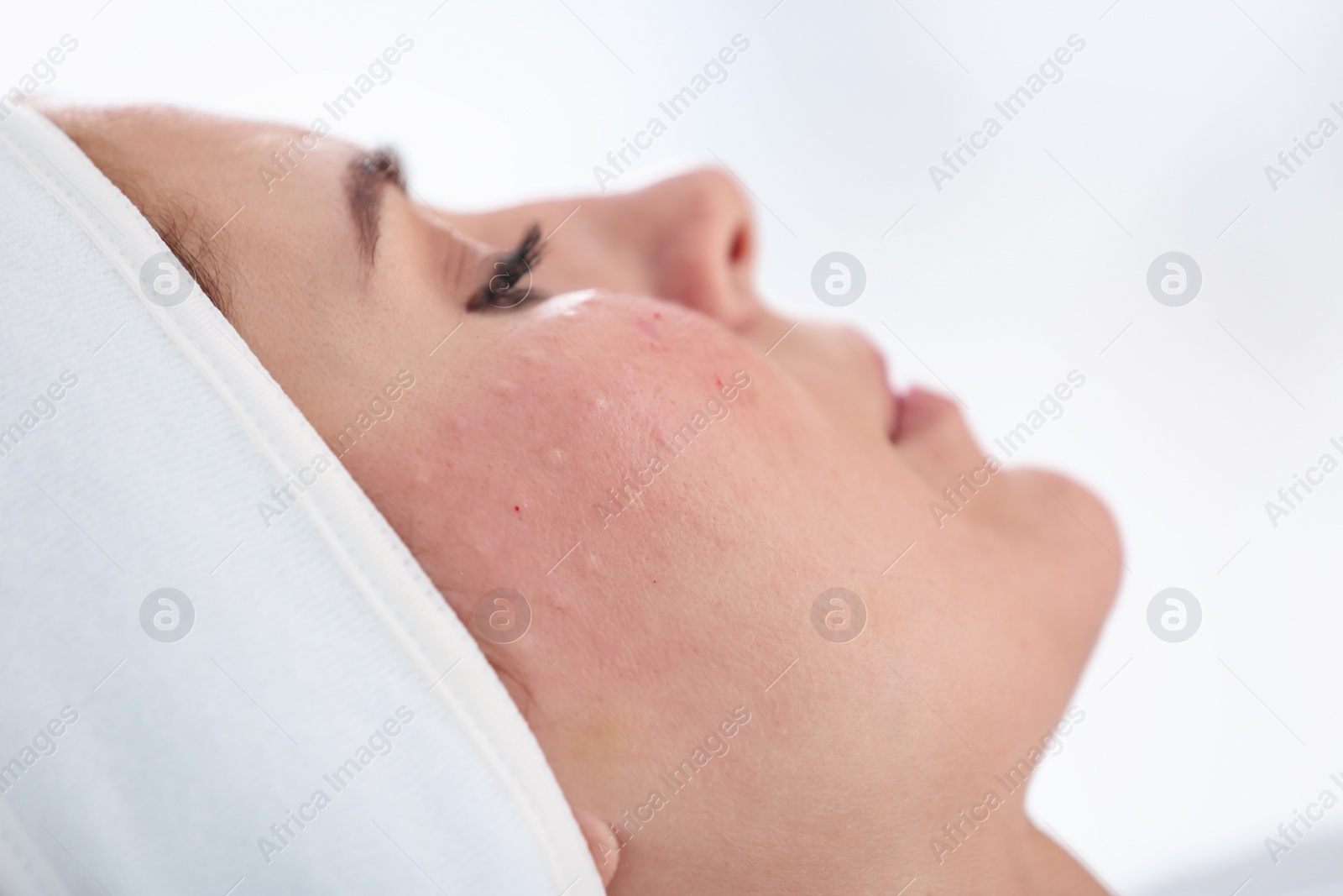 Photo of Woman after face biorevitalization procedure in salon, closeup. Cosmetic treatment