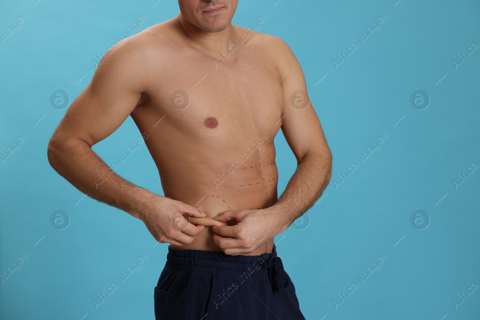 Photo of Closeup view of fit man with marks on body against light blue background, space for text. Weight loss surgery