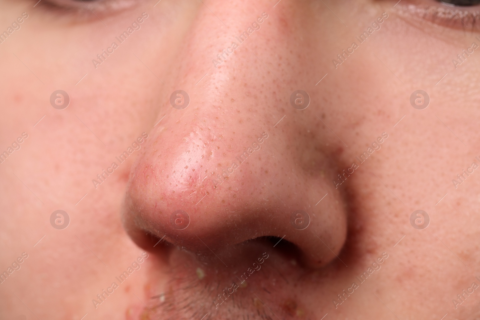 Photo of Young man with acne problem, closeup view of nose