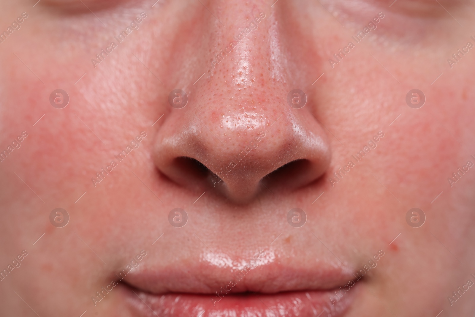 Photo of Closeup view of woman with reddened skin