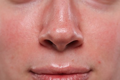 Photo of Closeup view of woman with reddened skin